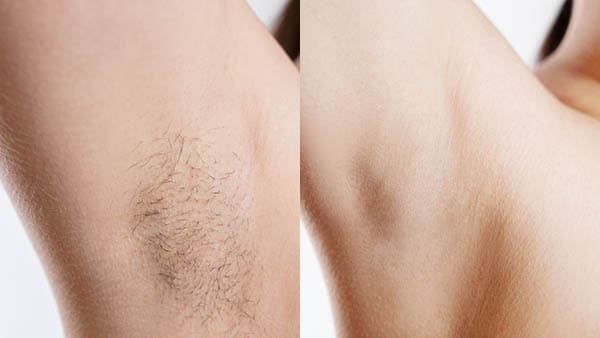epilation-laser-avant-apres-epilation-au-laser-prix-epilation-au-laser-paris-epilation-definitive-avant-apres-dr-elicha