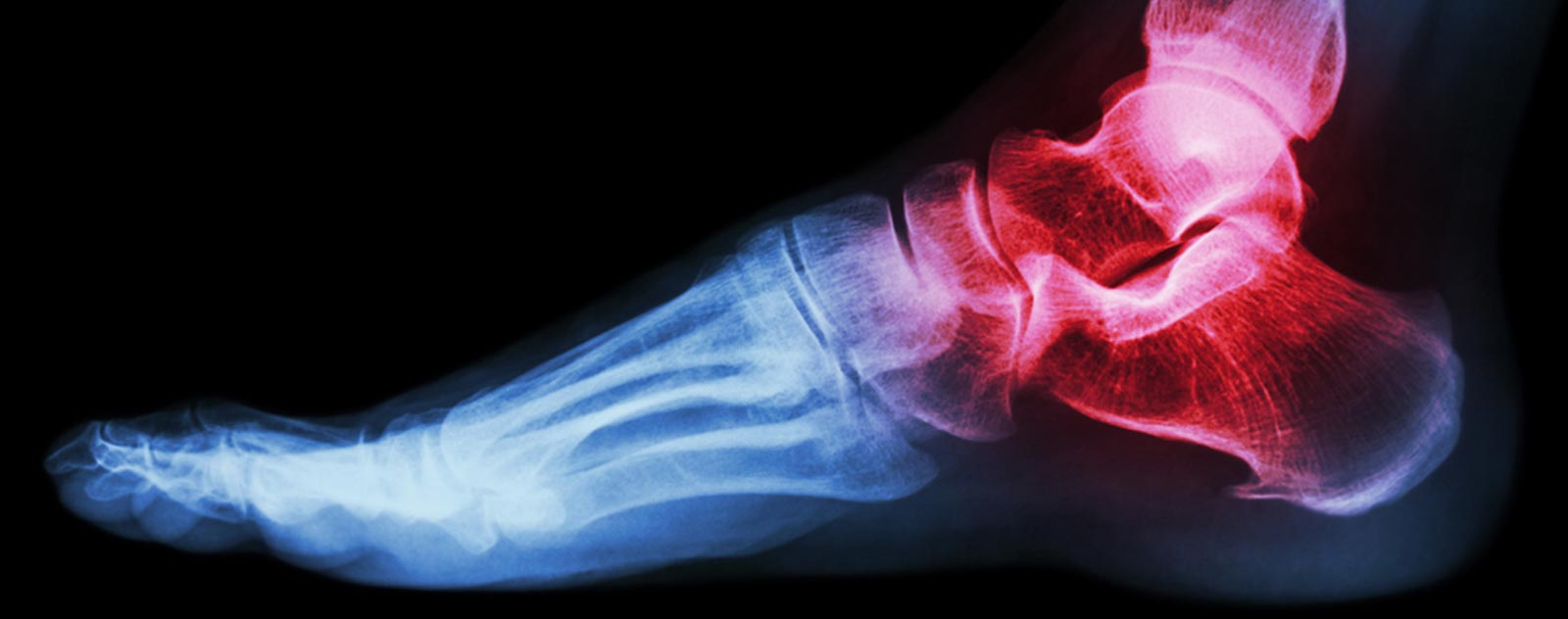 radiographies-flexion-plantaire-os-du-pieds-fait-une-entorse