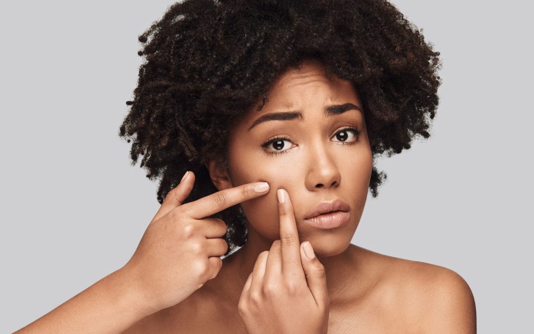 Quel maquillage pour peau acnéique ?